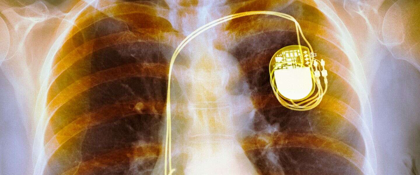 Never replace pacemaker batteries again thanks to your own body